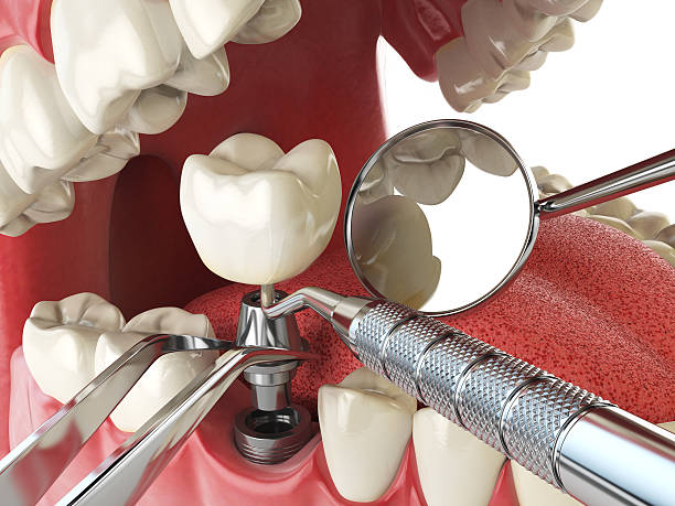 Best Emergency Broken Tooth Repair in Blue Mound, IL